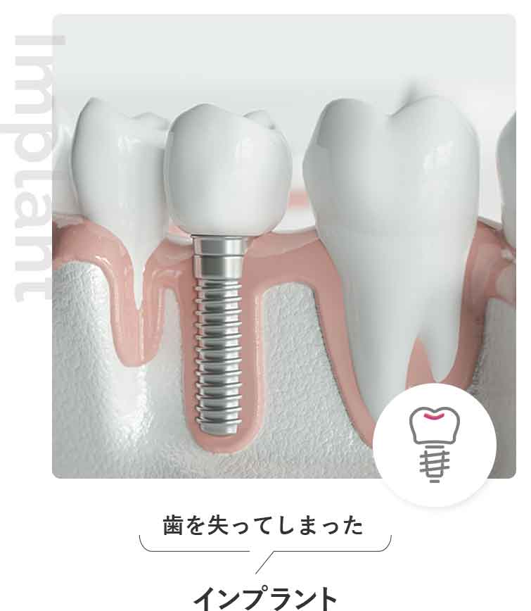 インプラント