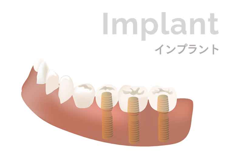 インプラント