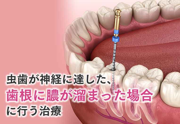根管治療