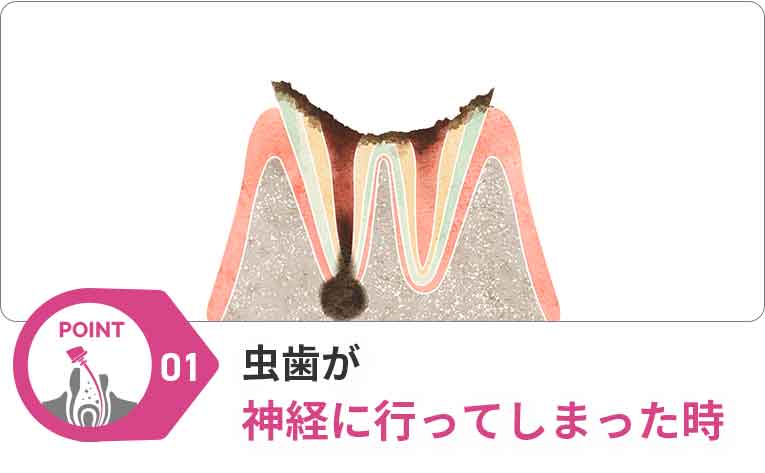 虫歯が神経に行ってしまった時