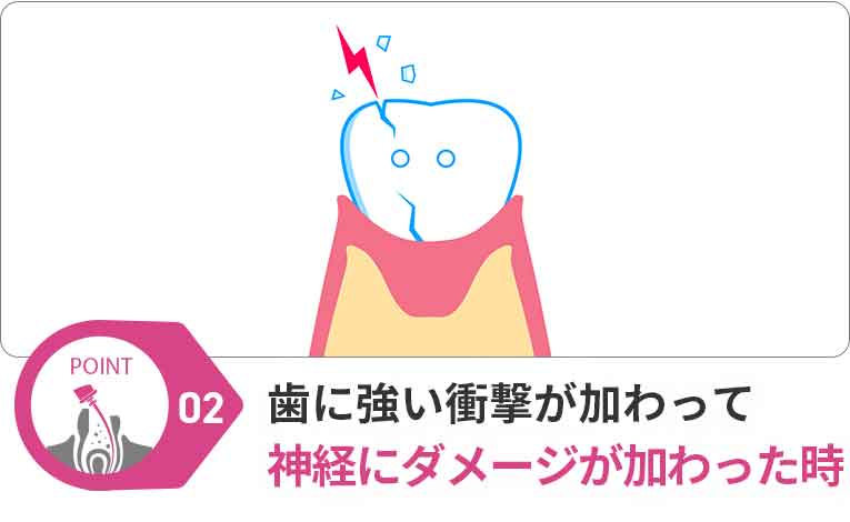 歯に強い衝撃が加わって神経にダメージが加わった時