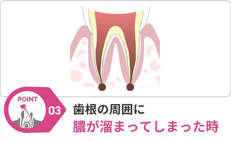 歯根の周囲に膿が溜まってしまった時
