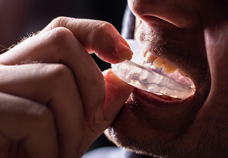 スポーツマウスガード