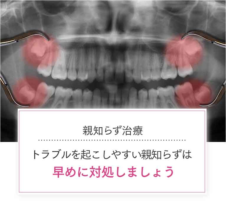 親知らず治療