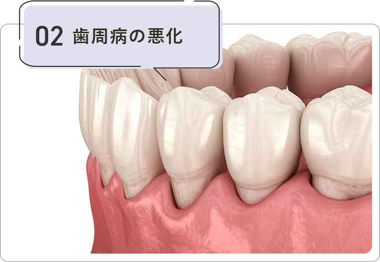 歯周病の悪化