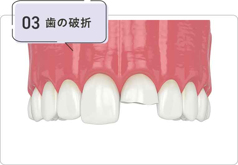 歯の破折