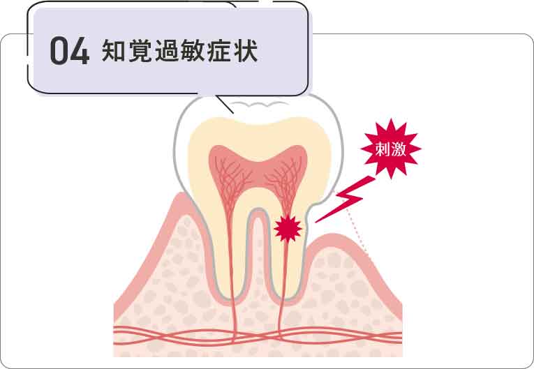 知覚過敏症状