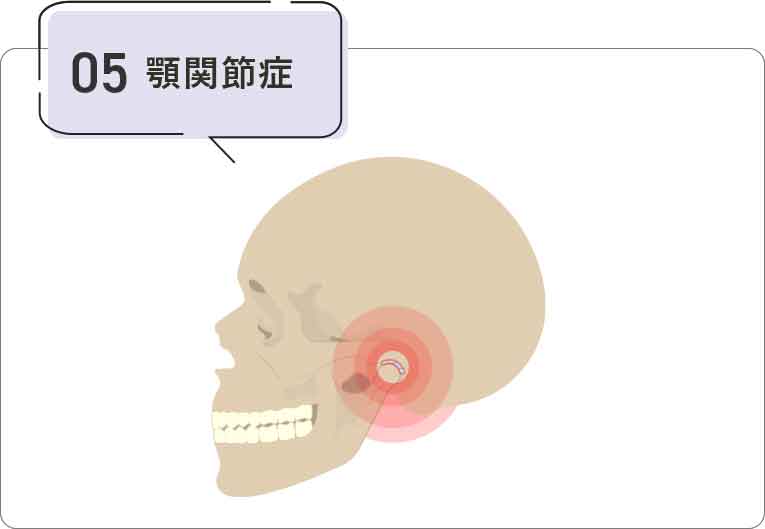 顎関節症