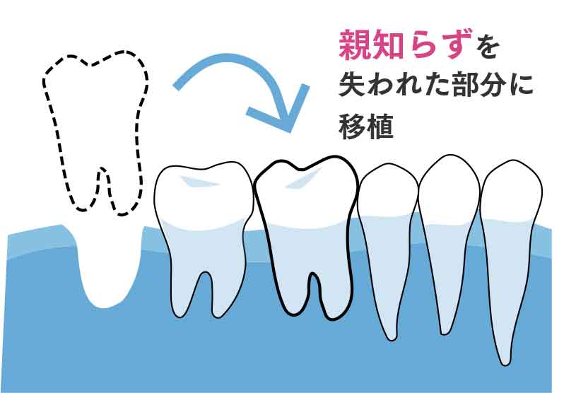 歯牙移植とは