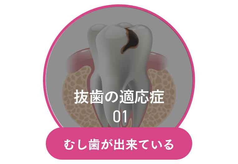 むし歯が出来ている
