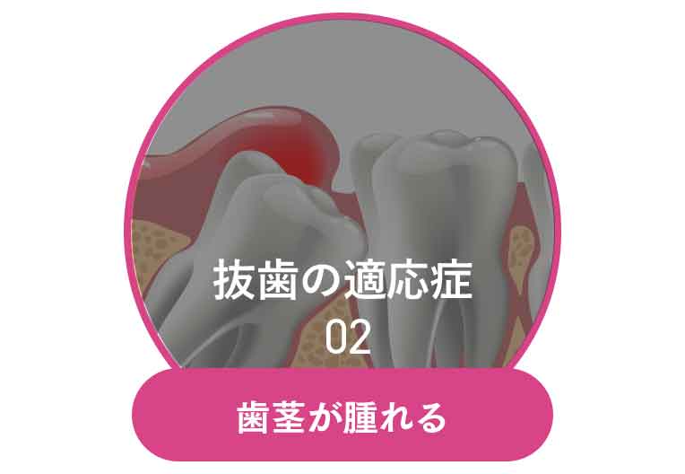 歯茎が腫れる