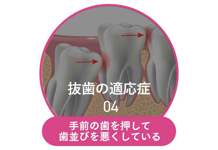 手前の歯を押して歯並びを悪くしている