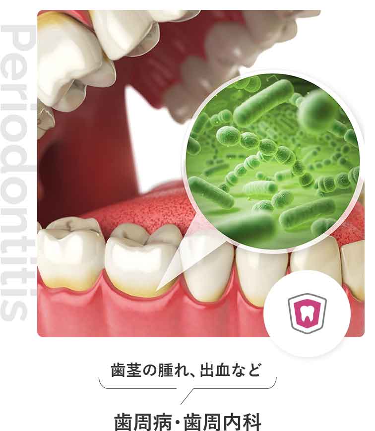 歯周病・歯周内科