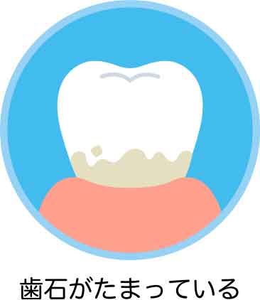 歯石がたまっている
