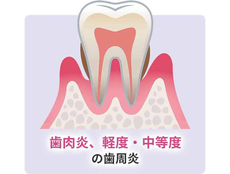 歯肉炎、軽度・中等度の歯周炎