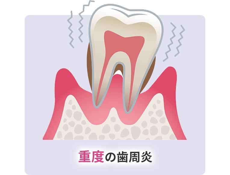 重度の歯周炎