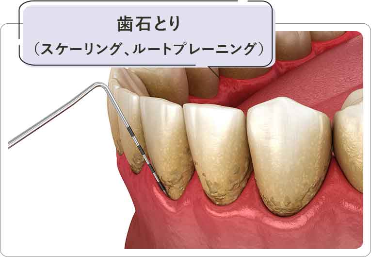 歯石とり