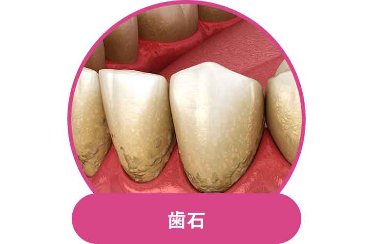 歯石