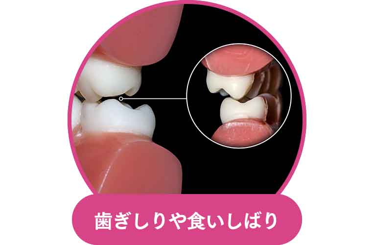 歯ぎしりや食いしばり