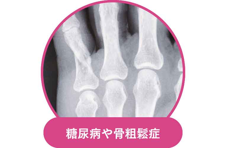 糖尿病や骨粗鬆症
