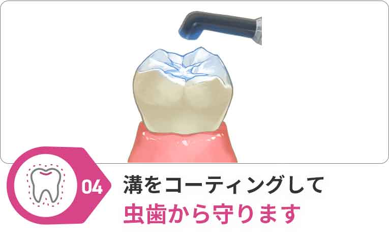 シーラント