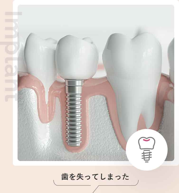 インプラント