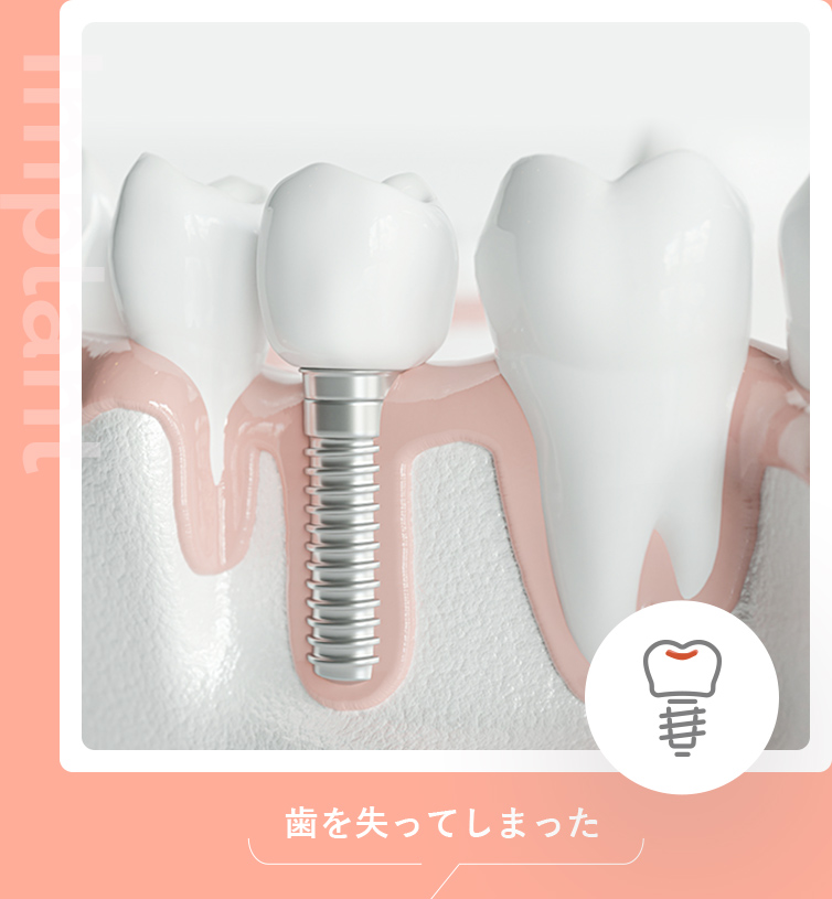 インプラント