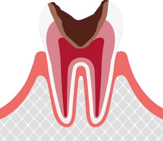 神経に及ぶ虫歯