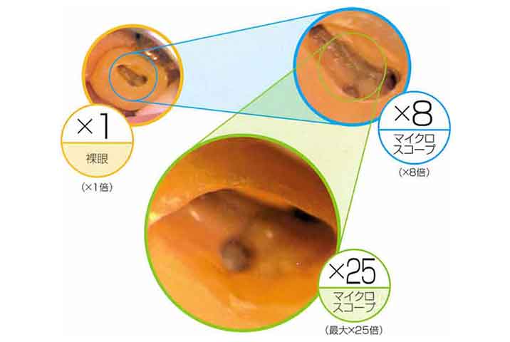 医療用顕微鏡を使って難しい根の治療の精度を高め、歯の寿命を延ばせる！