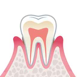 軽度歯周炎