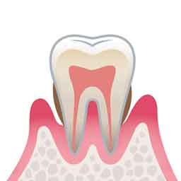 中等度歯周炎