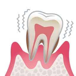 重度歯周炎
