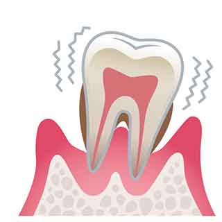 重度の歯周炎