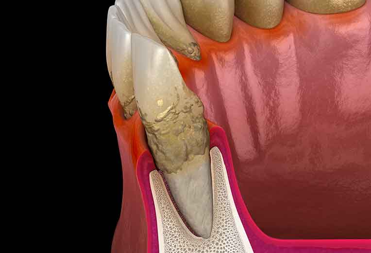 歯周病の直接の原因はプラーク