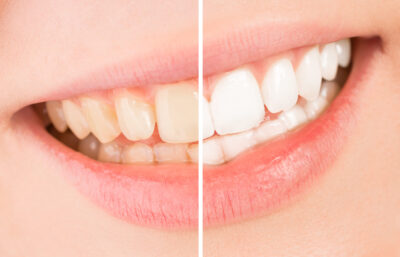 whitening_care_01