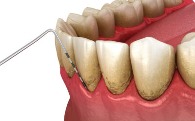 dental_calculus_02